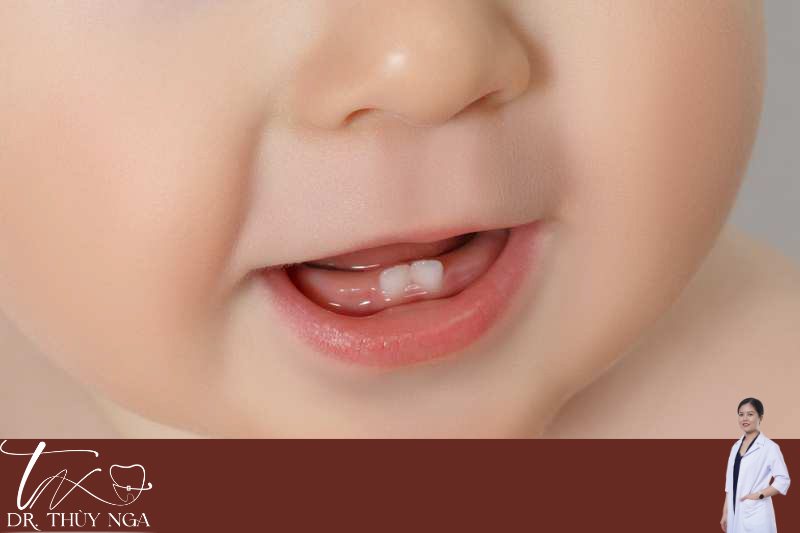 Những dấu hiệu mọc răng ở trẻ thường thấy