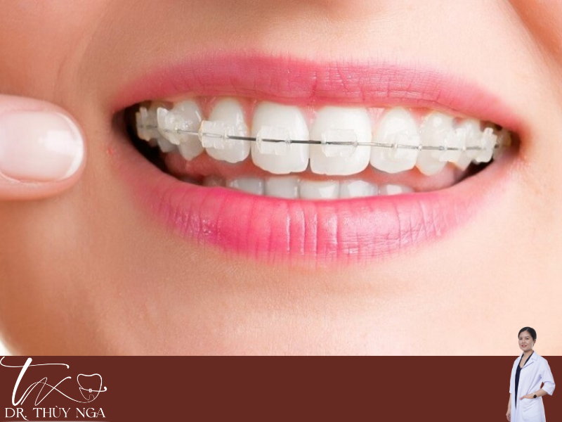 Vì sao nên chọn niềng răng tại Nha khoa thẩm mỹ Bedental?