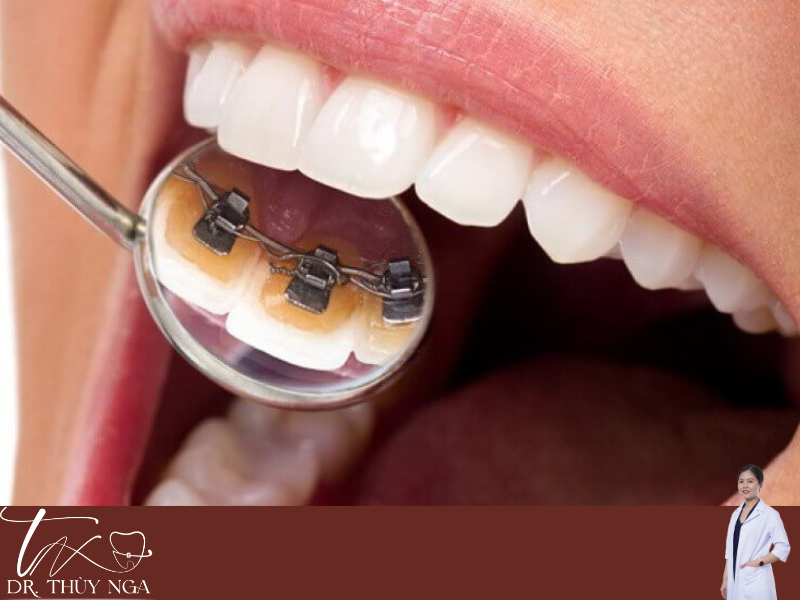 Lý do chi phí niềng răng khác nhau?